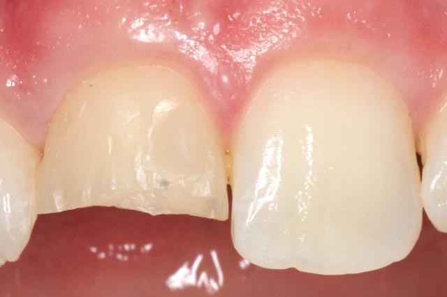 Dental Veneers before at Newport Beach Dental Solutions in Newport Beach, CA