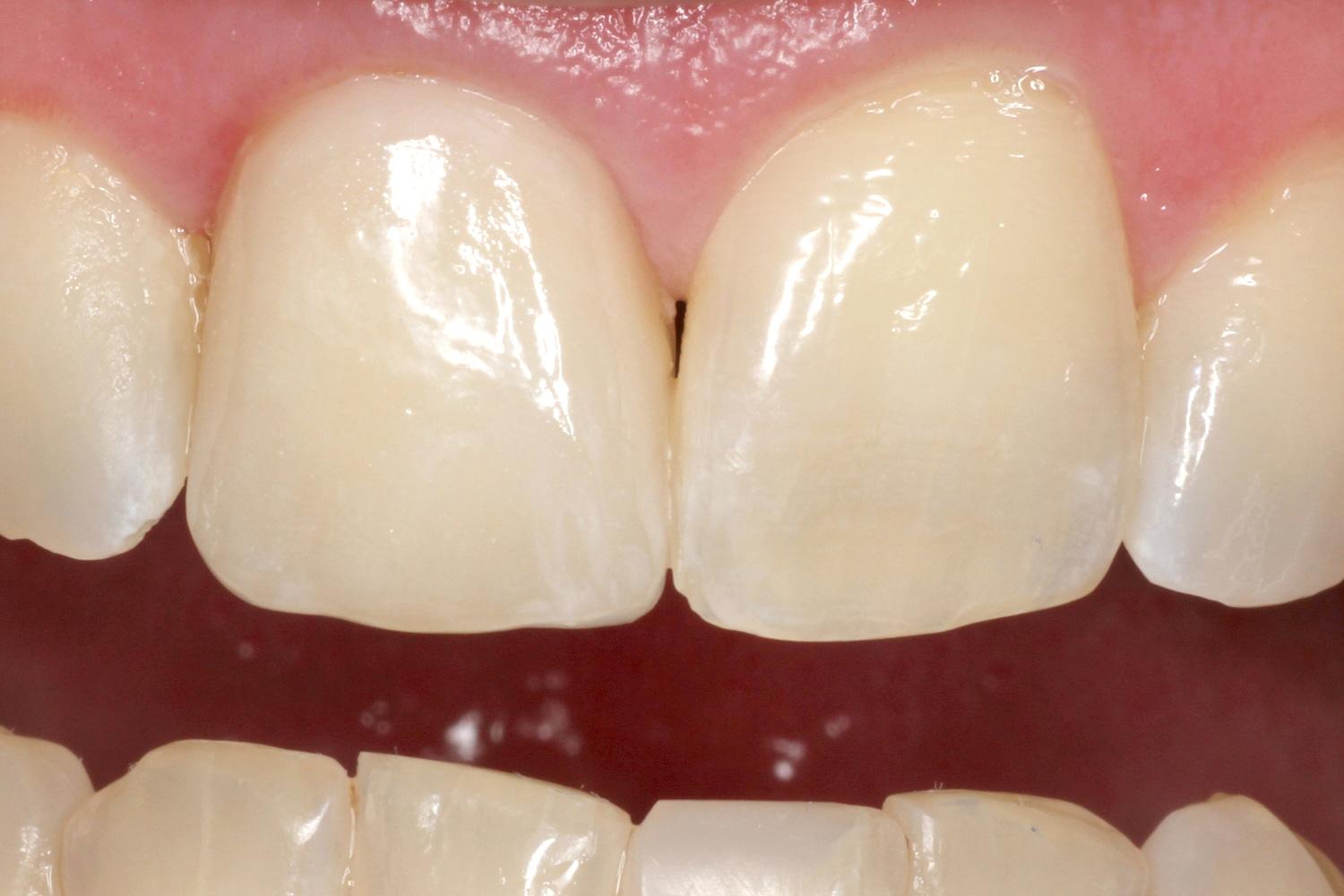 Newport Beach Dental Solutions smile makeover after — Newport Beach, CA