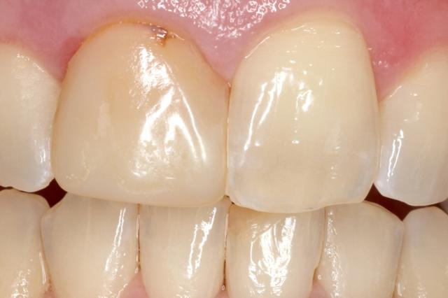 Smile Makeover before at Newport Beach Dental Solutions in Newport Beach, CA