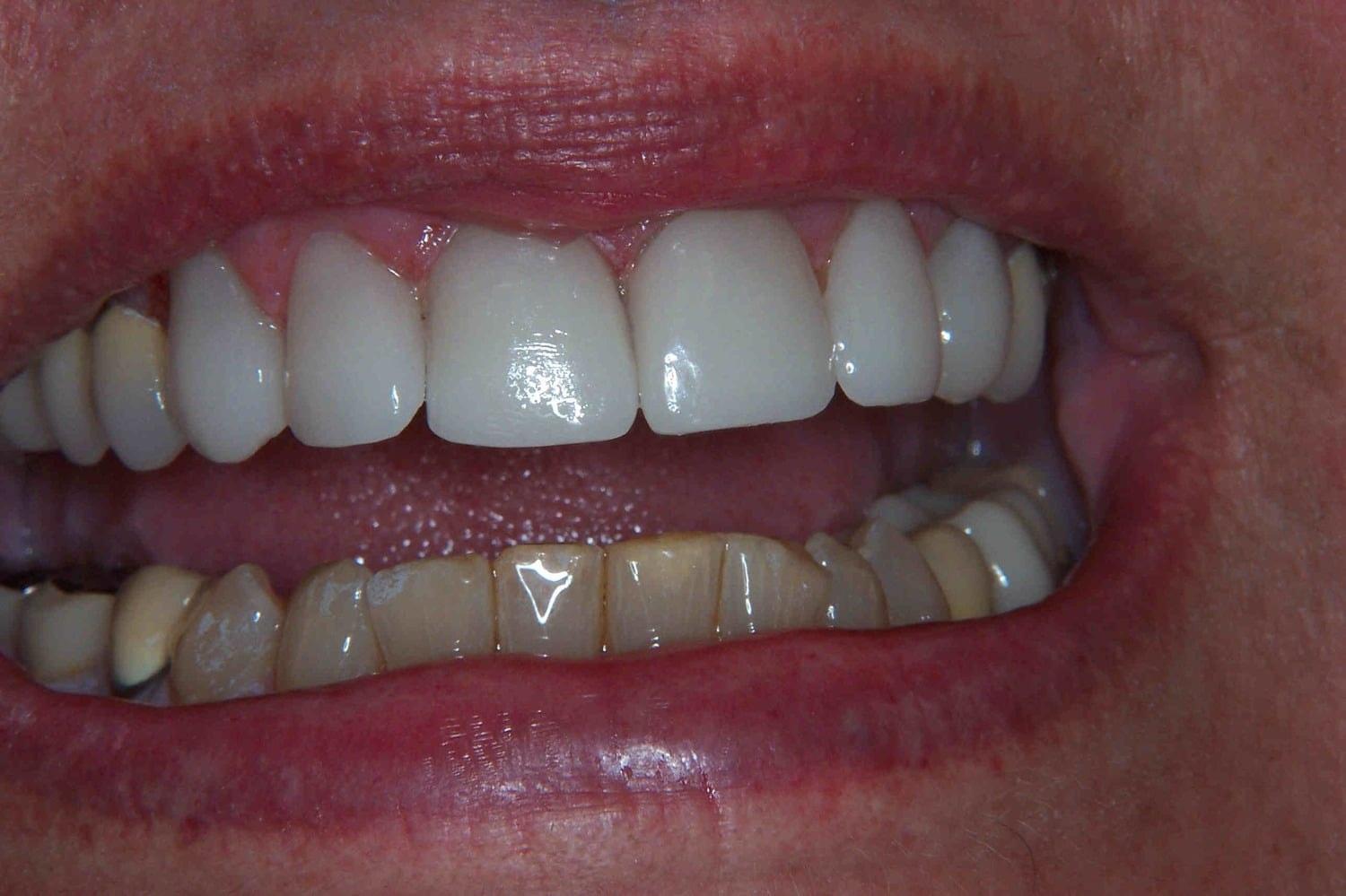 Newport Beach Dental Solutions veneers after — Newport Beach, CA