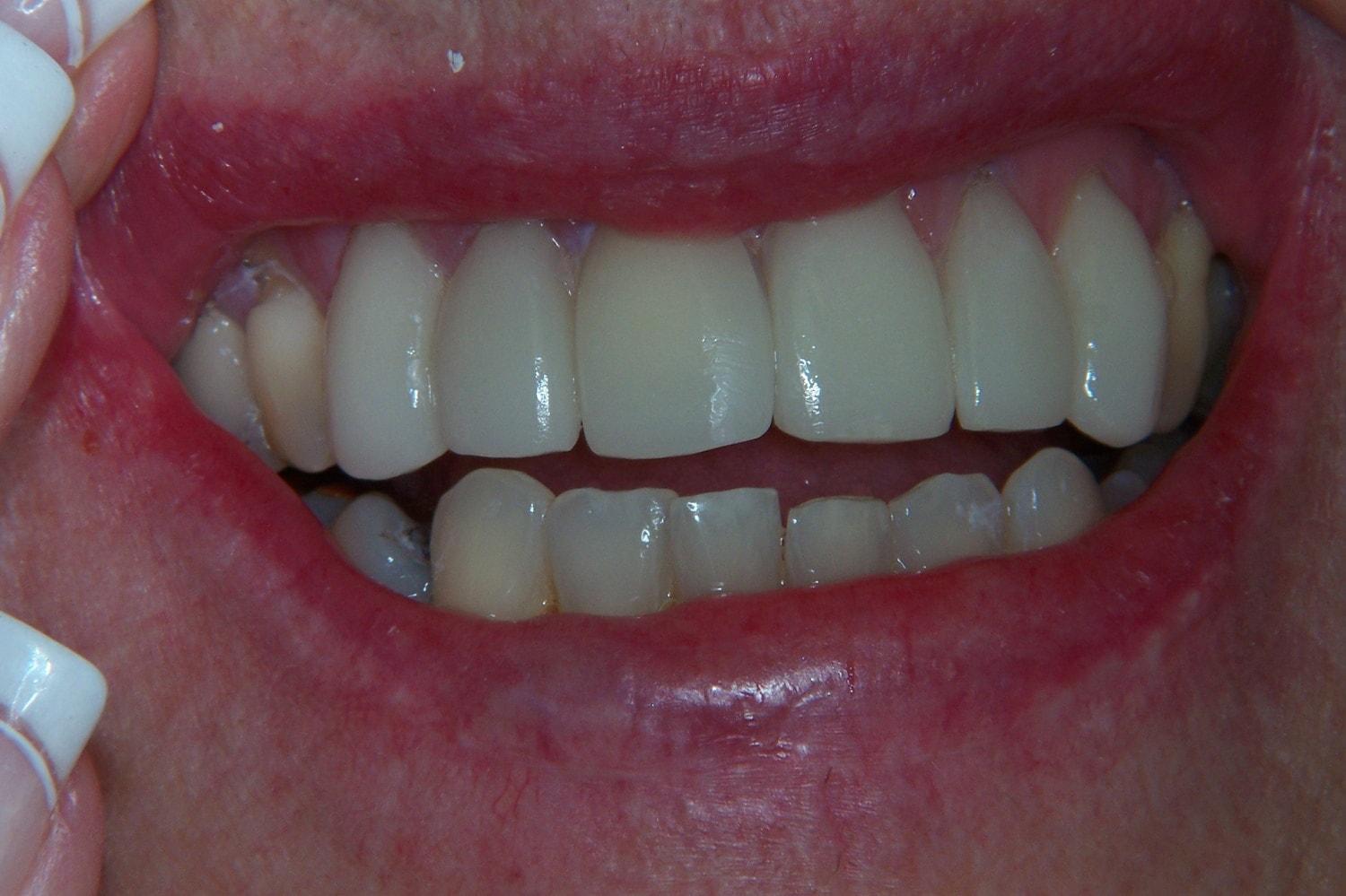 Newport Beach Dental Solutions veneers after — Newport Beach, CA