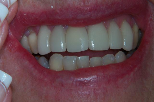 Dental Veneers after at Newport Beach Dental Solutions in Newport Beach, CA