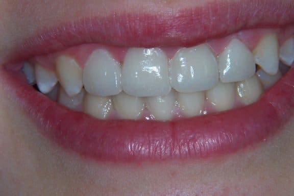 Dental Veneers after at Newport Beach Dental Solutions in Newport Beach, CA