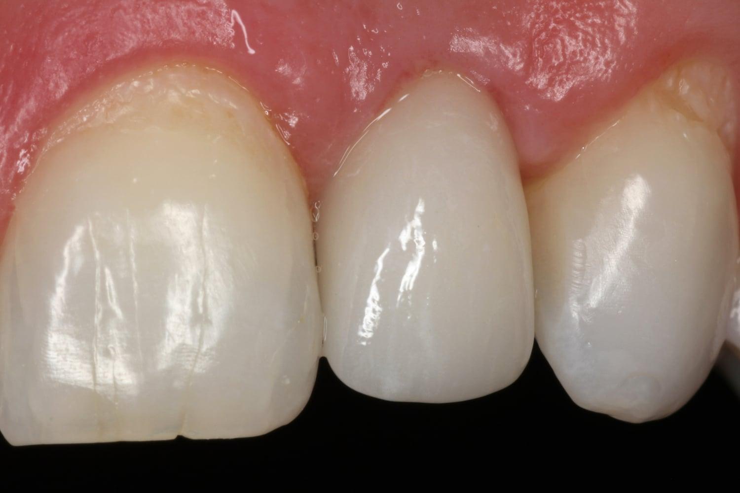 Newport Beach Dental Solutions dental implants after — Newport Beach, CA