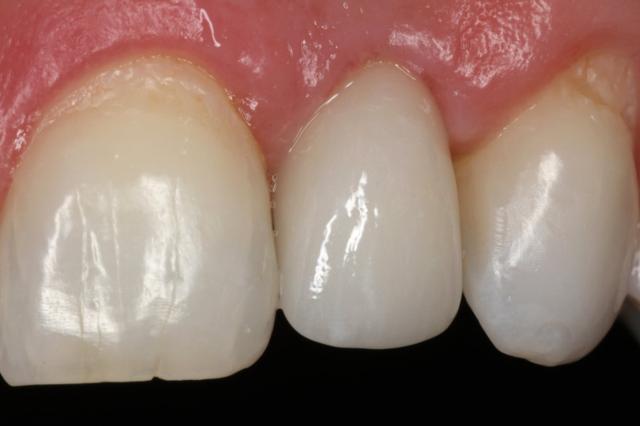 Dental Implants after at Newport Beach Dental Solutions in Newport Beach, CA