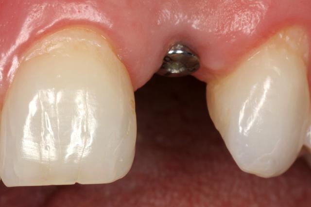 Dental Implants before at Newport Beach Dental Solutions in Newport Beach, CA