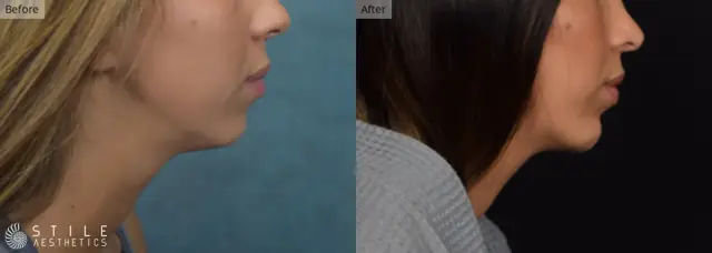 Chin Implant result at Stile Aesthetics in Las Vegas, NV