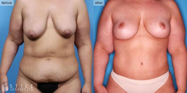 Mommy Makeover result at Stile Aesthetics in Las Vegas, NV