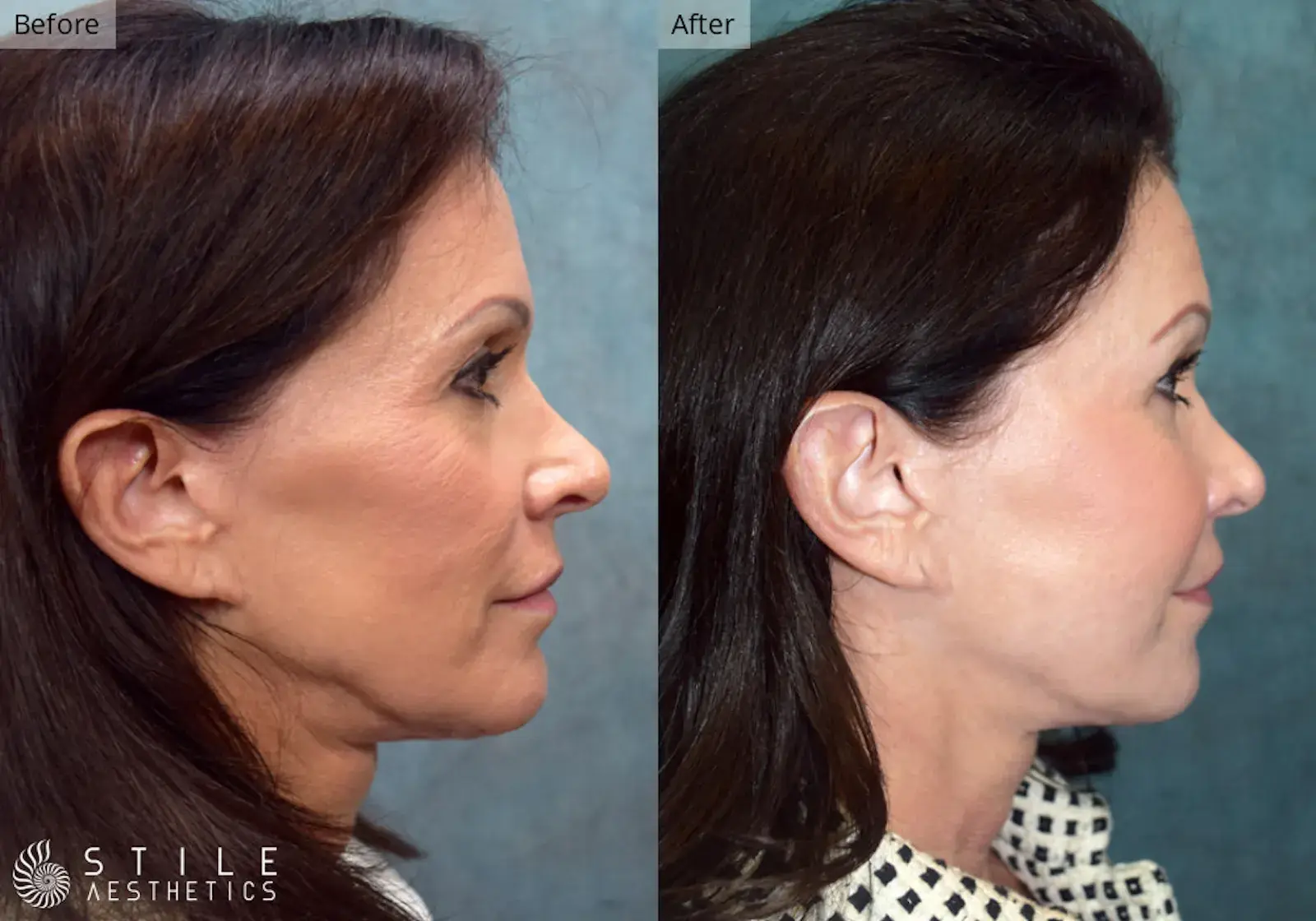 Stile Aesthetics fat transfer result — Las Vegas, NV