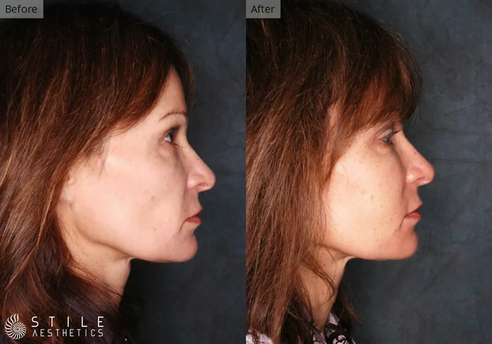 Stile Aesthetics fat transfer result — Las Vegas, NV