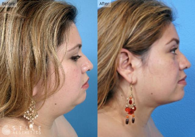 Liposuction result at Stile Aesthetics in Las Vegas, NV