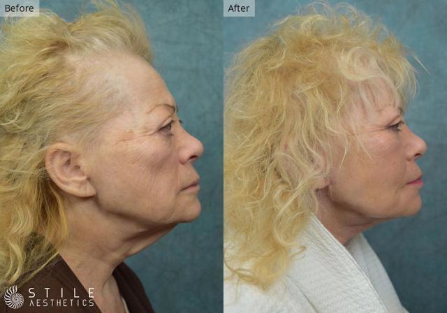 Neck Lift result at Stile Aesthetics in Las Vegas, NV