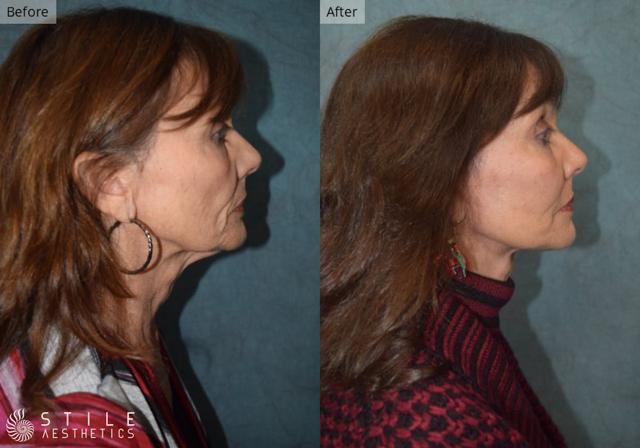 Neck Lift result at Stile Aesthetics in Las Vegas, NV