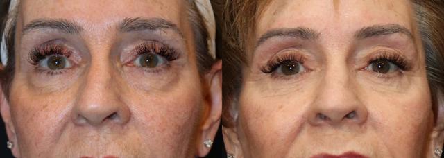 Blepharoplasty result at Stile Aesthetics in Las Vegas, NV