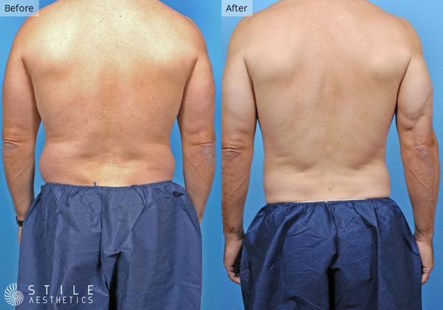 Liposuction result at Stile Aesthetics in Las Vegas, NV