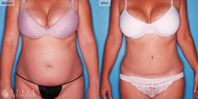 Tummy Tuck result at Stile Aesthetics in Las Vegas, NV