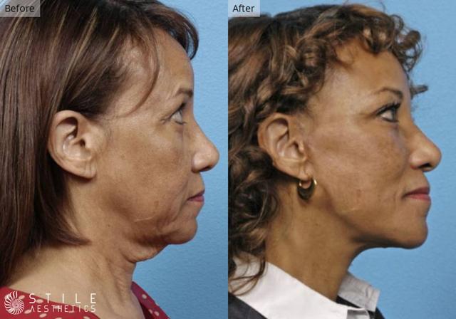 Neck Lift result at Stile Aesthetics in Las Vegas, NV