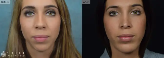 Chin Implant result at Stile Aesthetics in Las Vegas, NV