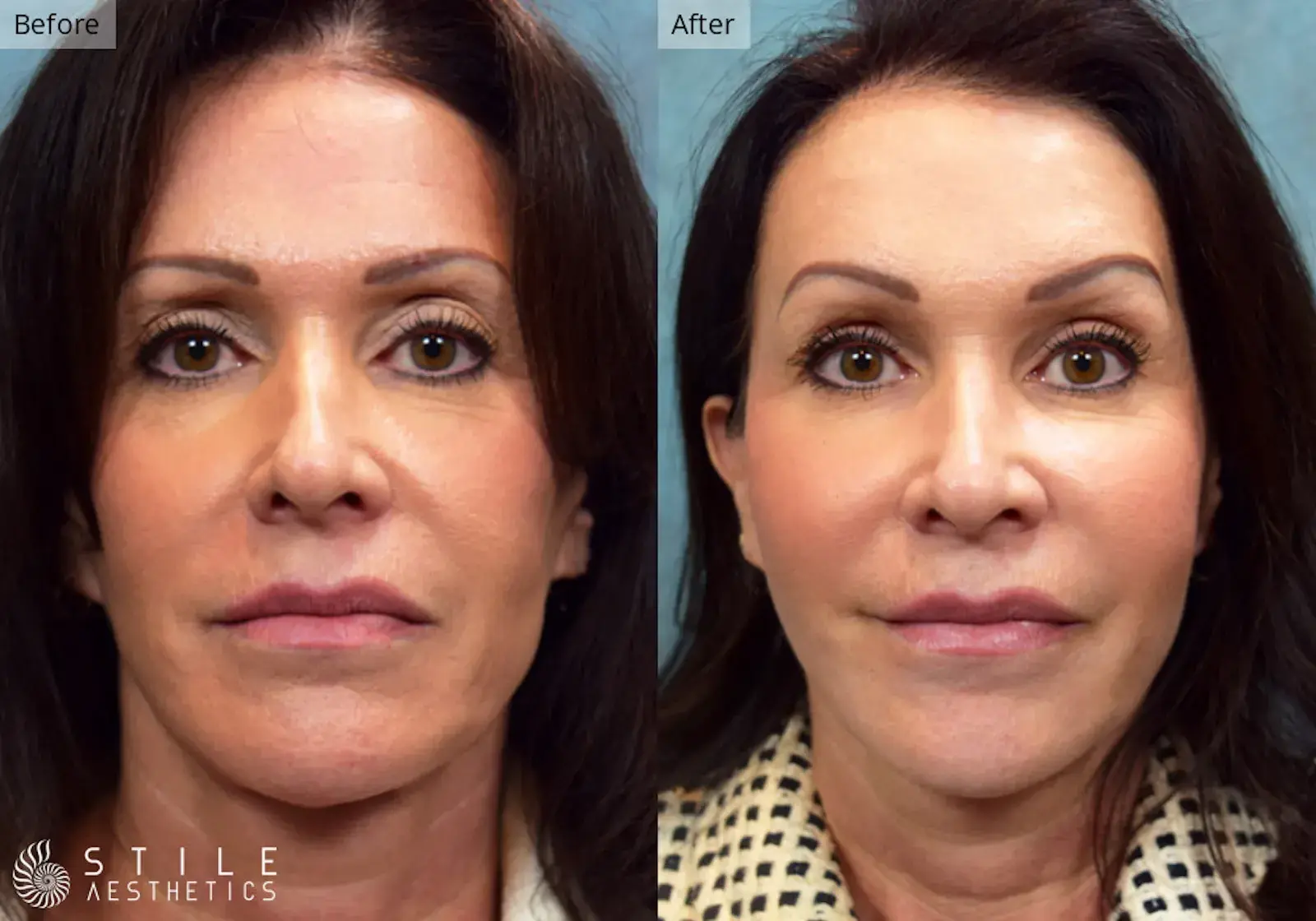 Stile Aesthetics fat transfer result — Las Vegas, NV