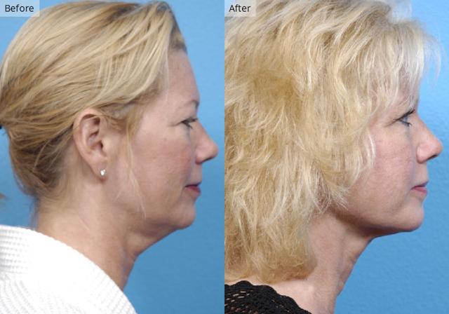 Neck Liposuction result at Stile Aesthetics in Las Vegas, NV