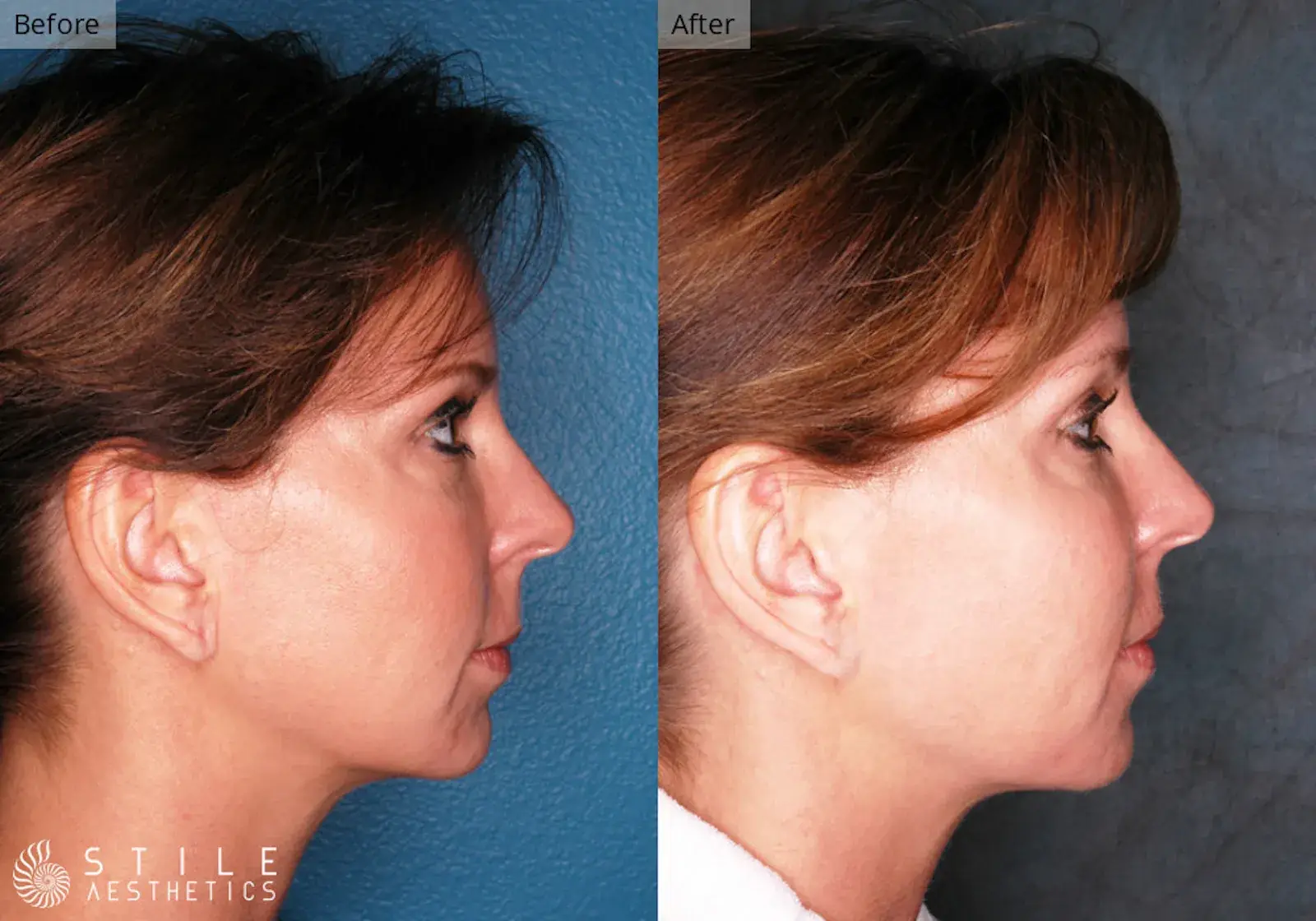 Stile Aesthetics fat transfer result — Las Vegas, NV
