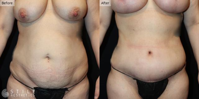 Mommy Makeover result at Stile Aesthetics in Las Vegas, NV