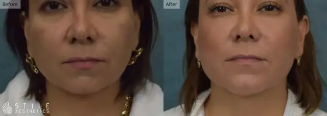 Chin Implant result at Stile Aesthetics in Las Vegas, NV