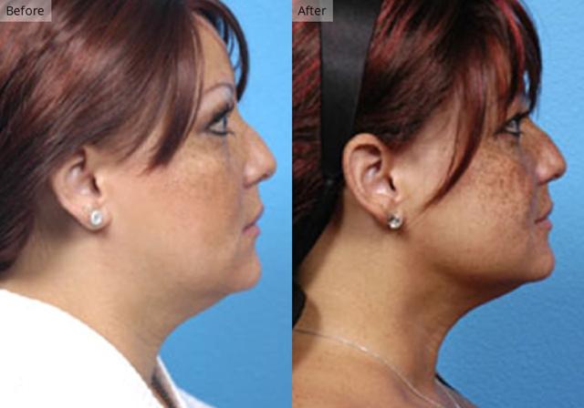 Neck Liposuction result at Stile Aesthetics in Las Vegas, NV