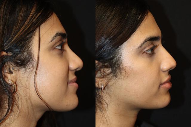 Rhinoplasty result at Stile Aesthetics in Las Vegas, NV