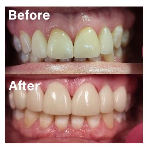 Dental Veneers result at Common Sense Family Dentistry in St. George, UT