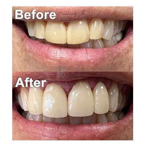 Smile Makeover result at Common Sense Family Dentistry in St. George, UT