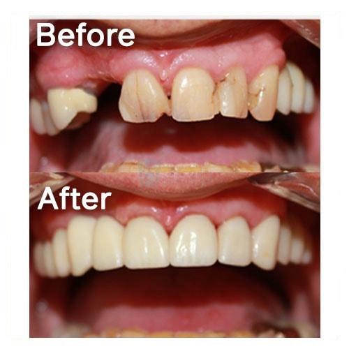 Smile Makeover result at Common Sense Family Dentistry in St. George, UT