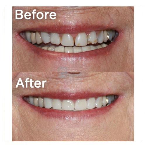 Smile Makeover result at Common Sense Family Dentistry in St. George, UT