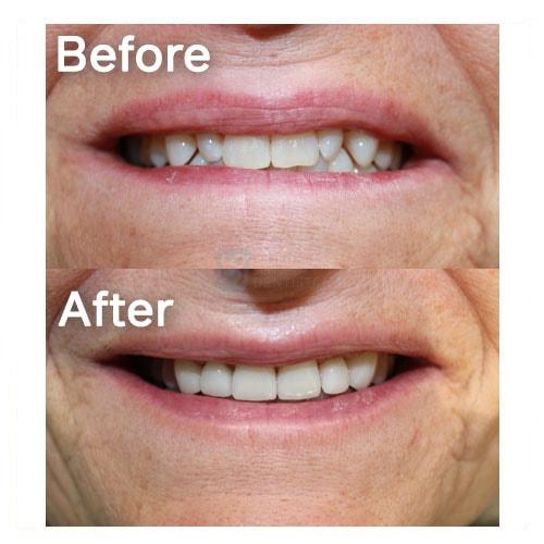 Smile Makeover result at Common Sense Family Dentistry in St. George, UT