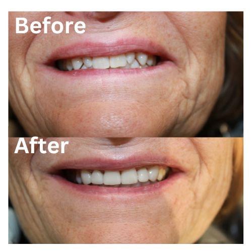 Dental Crowns result at Common Sense Family Dentistry in St. George, UT