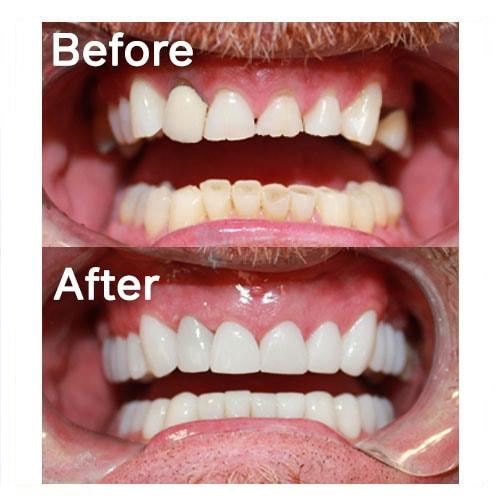 Smile Makeover result at Common Sense Family Dentistry in St. George, UT