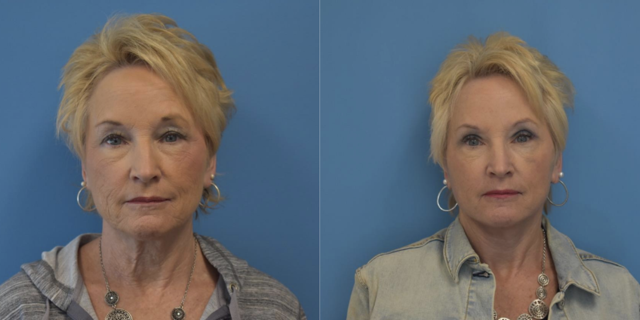 Neck Lift result at West End Facial Plastic Surgery in Richmond, VA