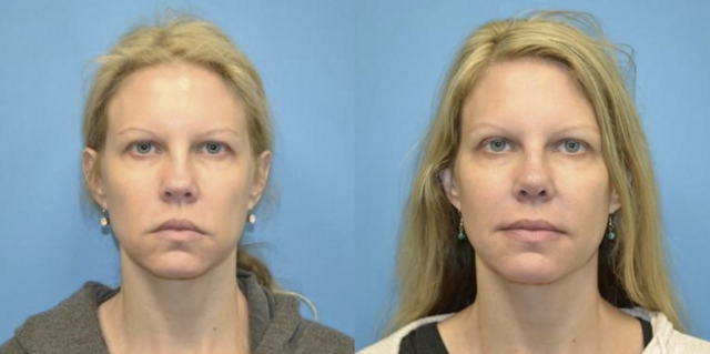 Rhinoplasty result at West End Facial Plastic Surgery in Richmond, VA