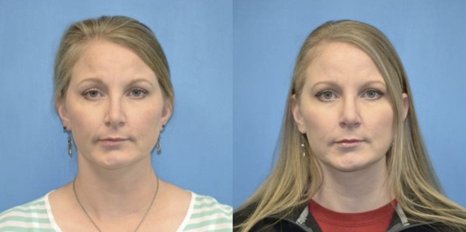 West End Facial Plastic Surgery rhinoplasty result — Richmond, VA