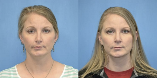 Rhinoplasty result at West End Facial Plastic Surgery in Richmond, VA