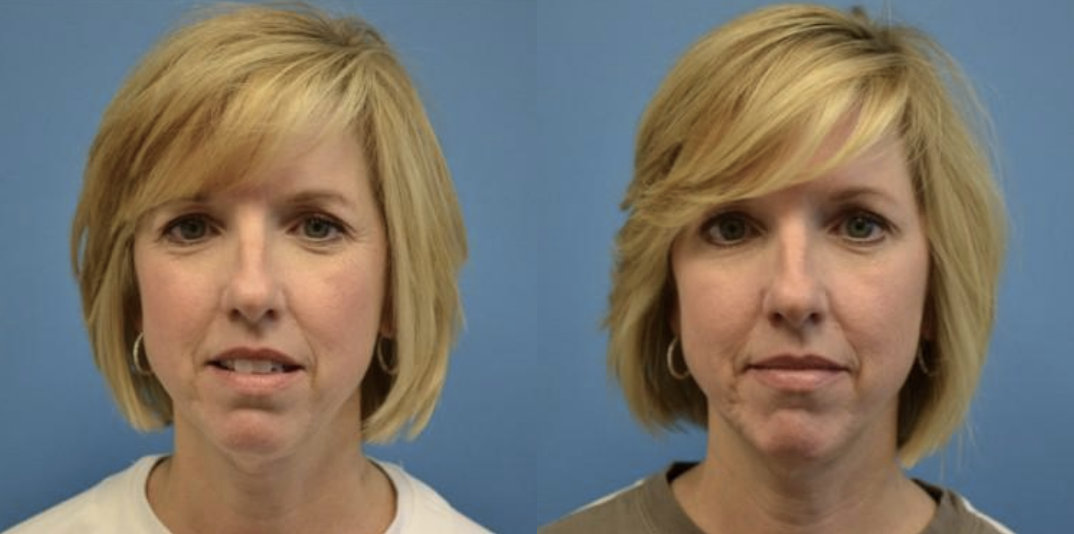 West End Facial Plastic Surgery otoplasty result — Richmond, VA