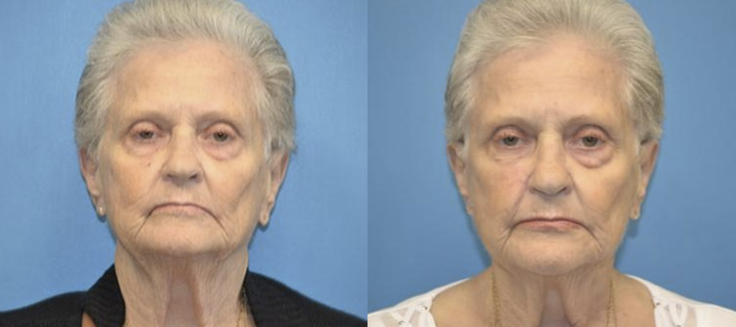 West End Facial Plastic Surgery otoplasty result — Richmond, VA