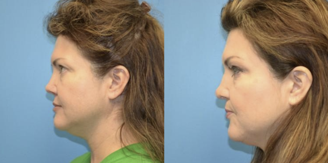 Rhinoplasty result at West End Facial Plastic Surgery in Richmond, VA