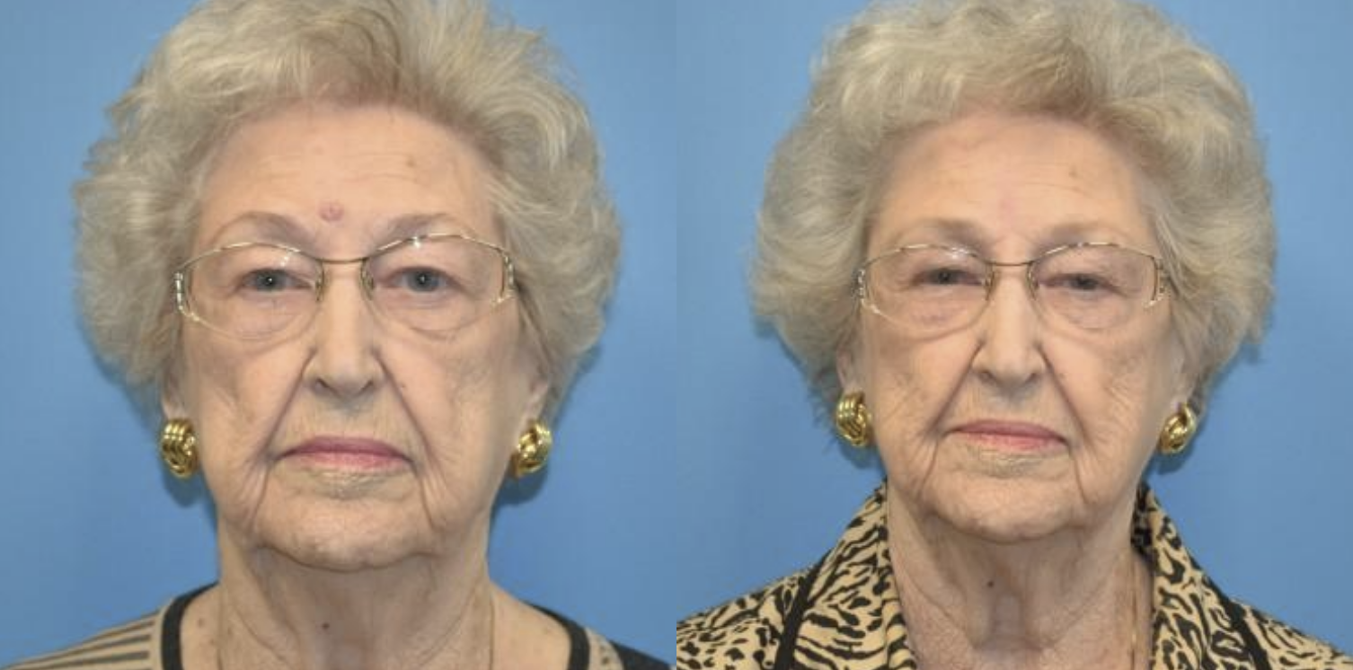 West End Facial Plastic Surgery otoplasty result — Richmond, VA