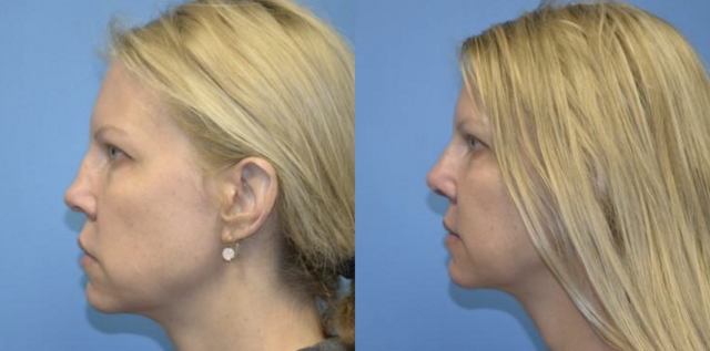Rhinoplasty result at West End Facial Plastic Surgery in Richmond, VA