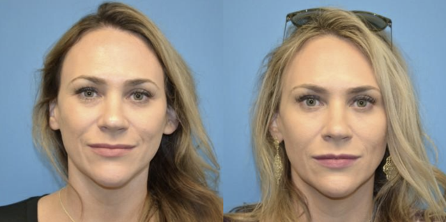 Botox result at West End Facial Plastic Surgery in Richmond, VA