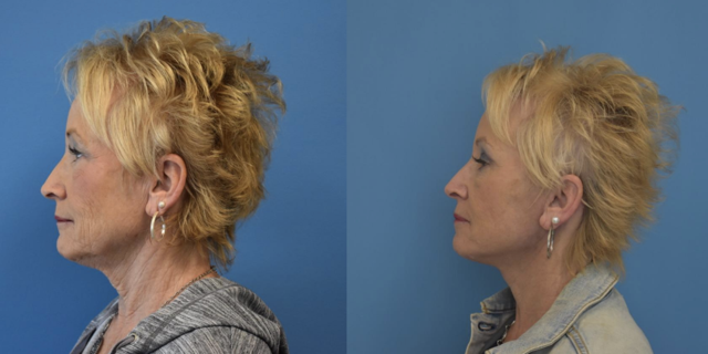 Neck Lift result at West End Facial Plastic Surgery in Richmond, VA