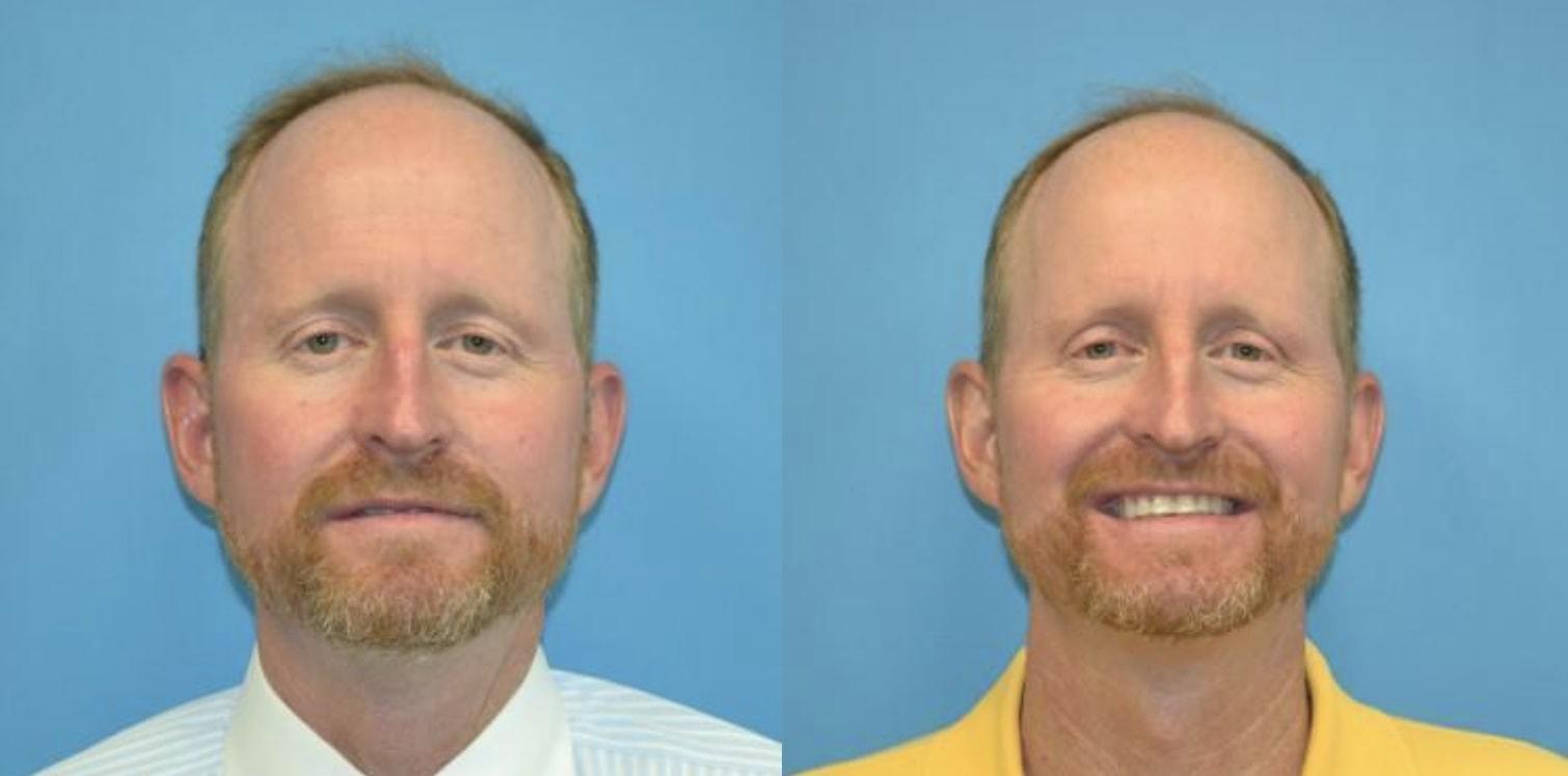 West End Facial Plastic Surgery eyelid lift result — Richmond, VA