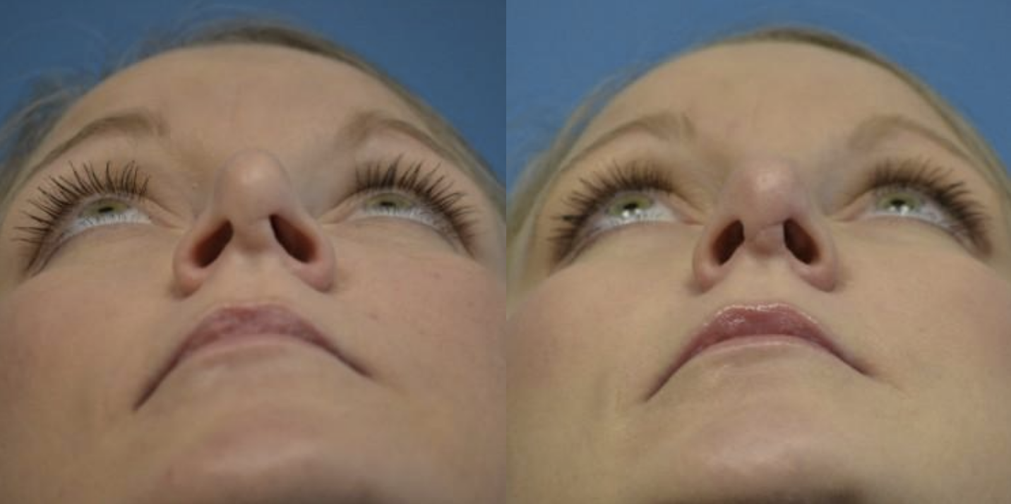 West End Facial Plastic Surgery rhinoplasty result — Richmond, VA