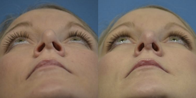 Rhinoplasty result at West End Facial Plastic Surgery in Richmond, VA